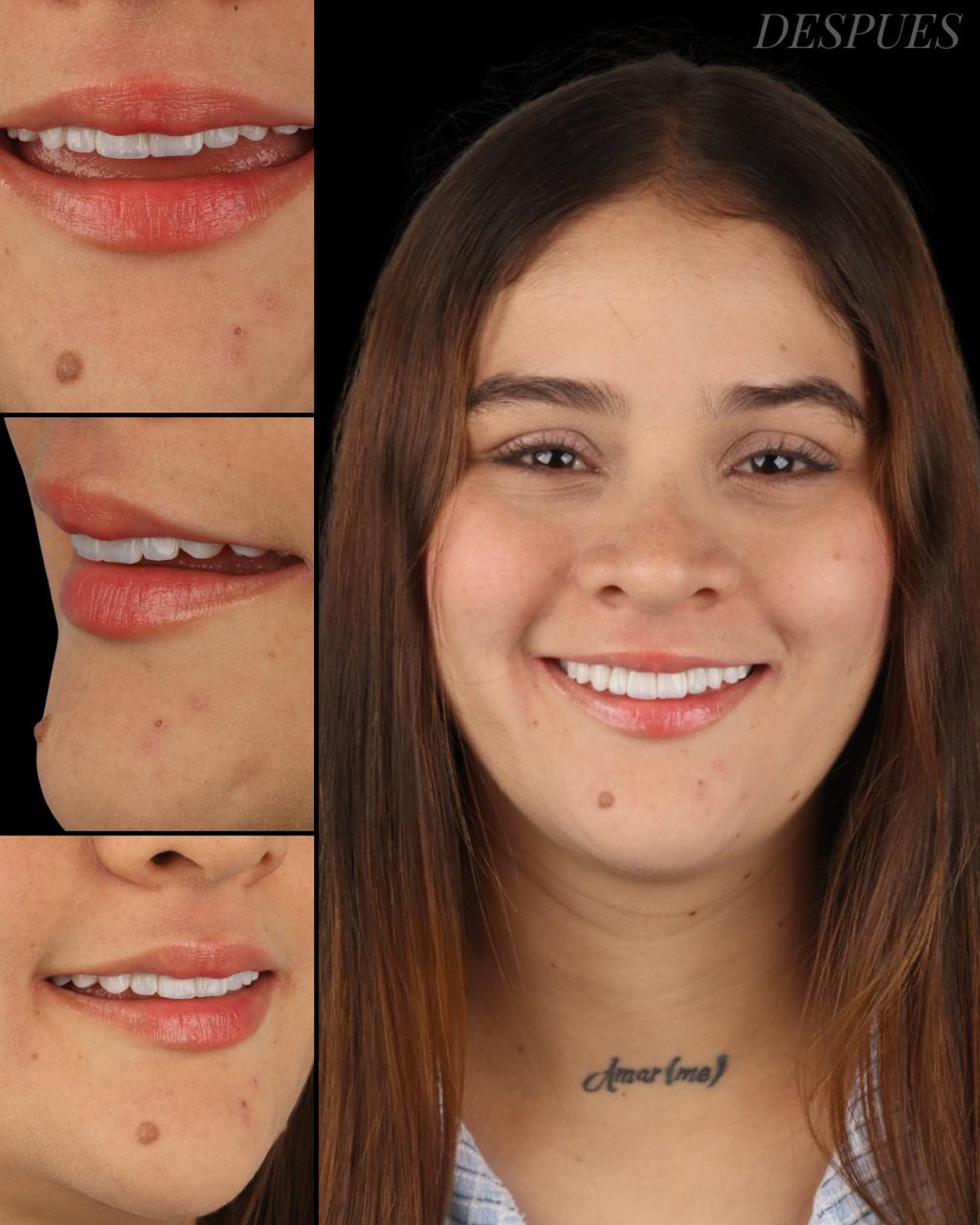 Resultado diseño sonrisa