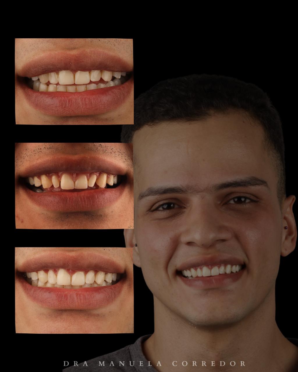 Diseño dental