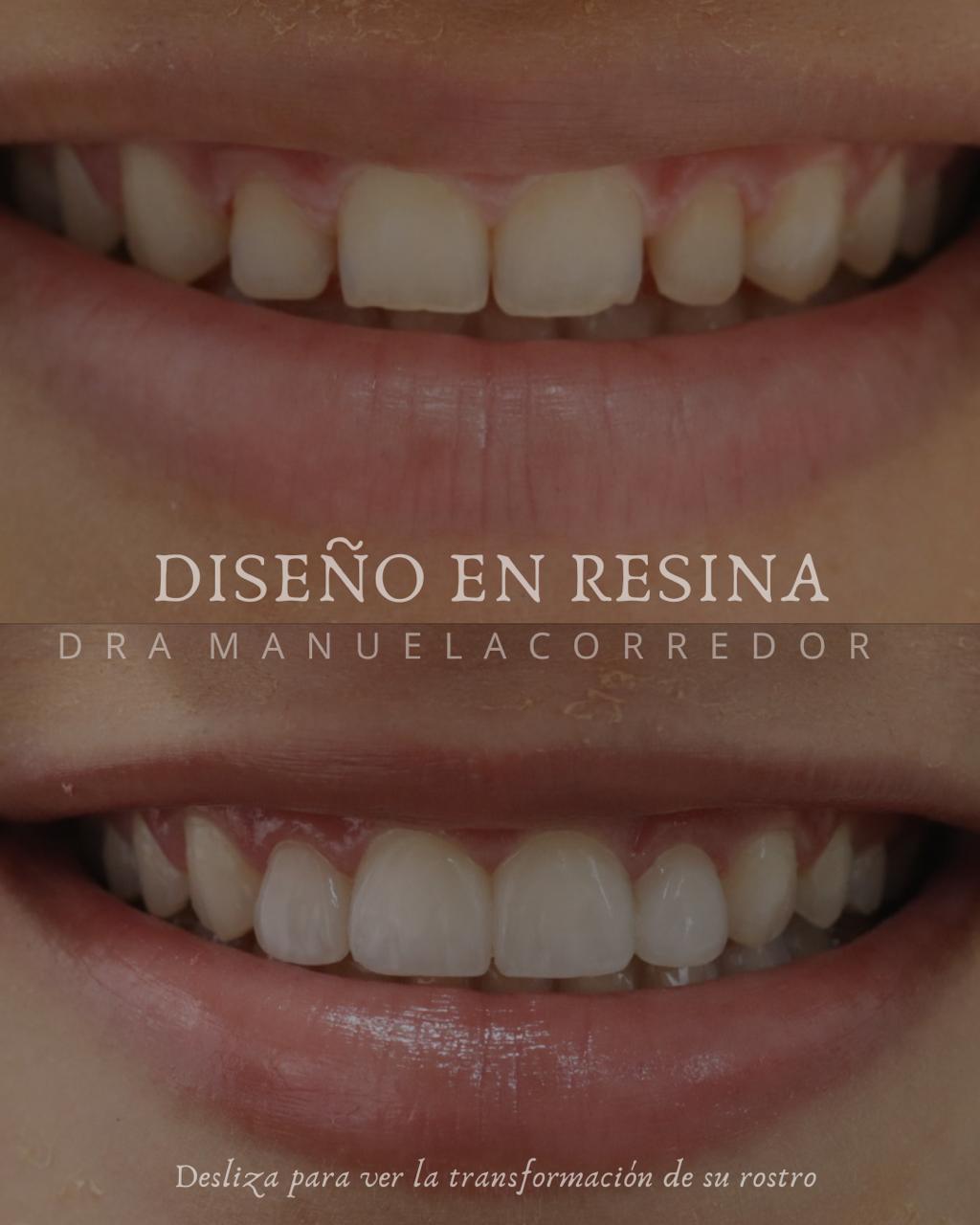 Cuidados diseño de sonrisa