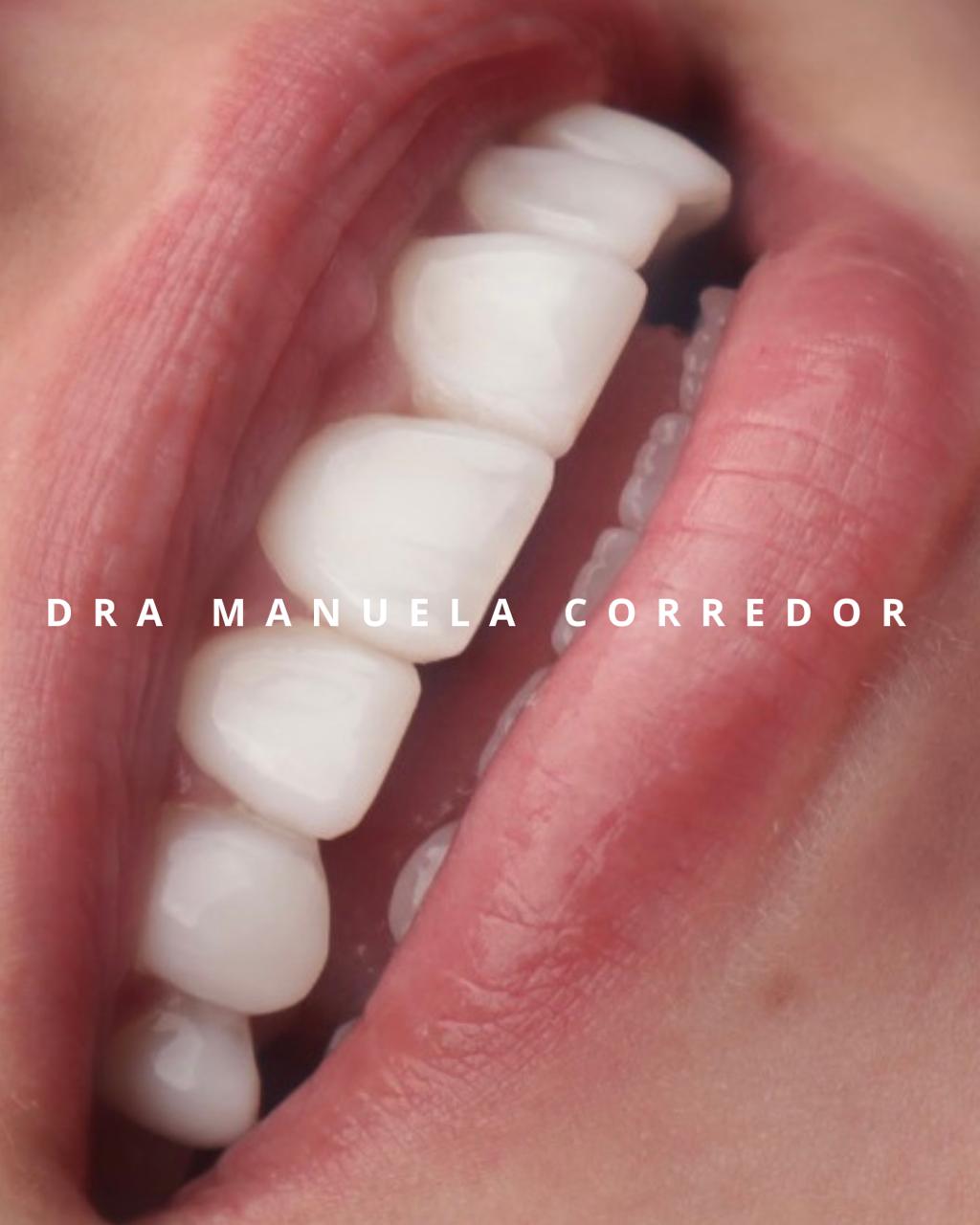 Diseño de sonrisa caso clínico