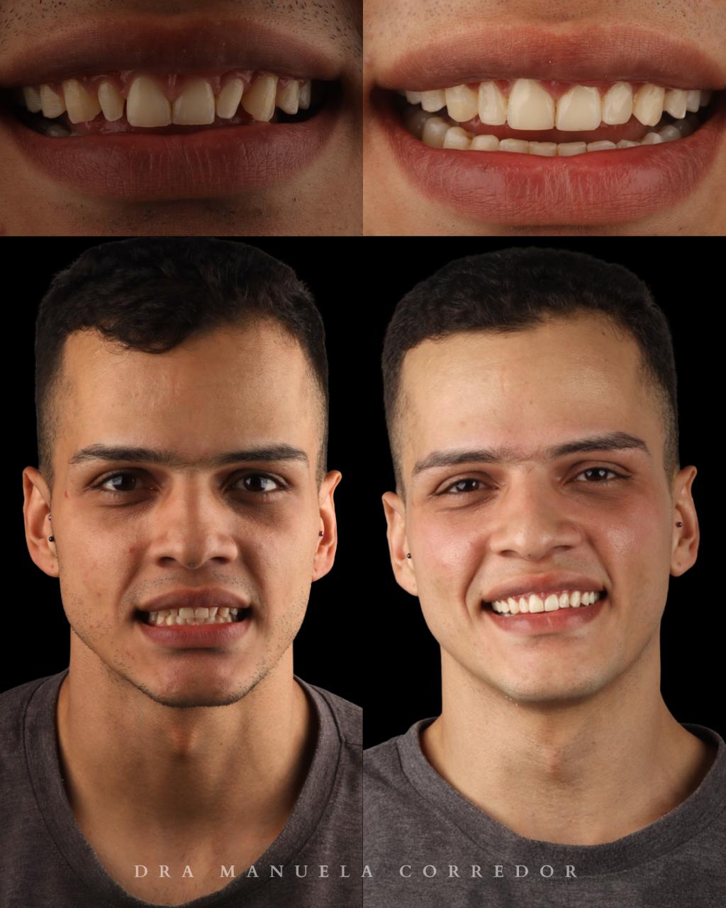 Caso antes y después