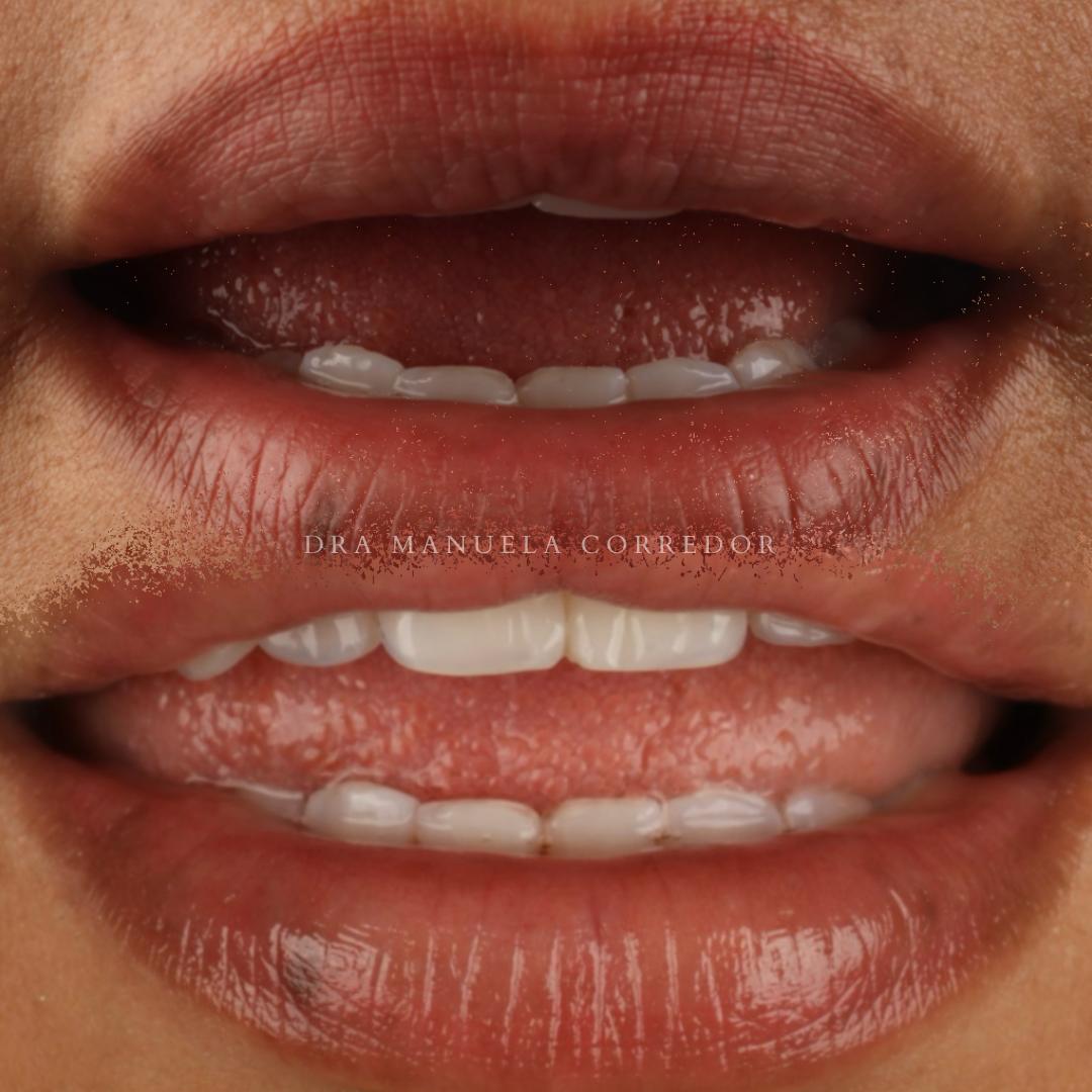Resultado estética dental