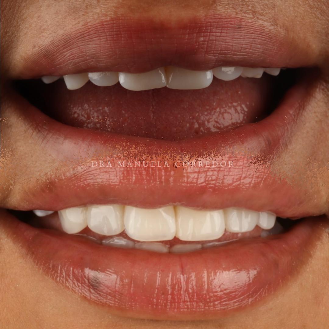 Caso diseño de sonrisa