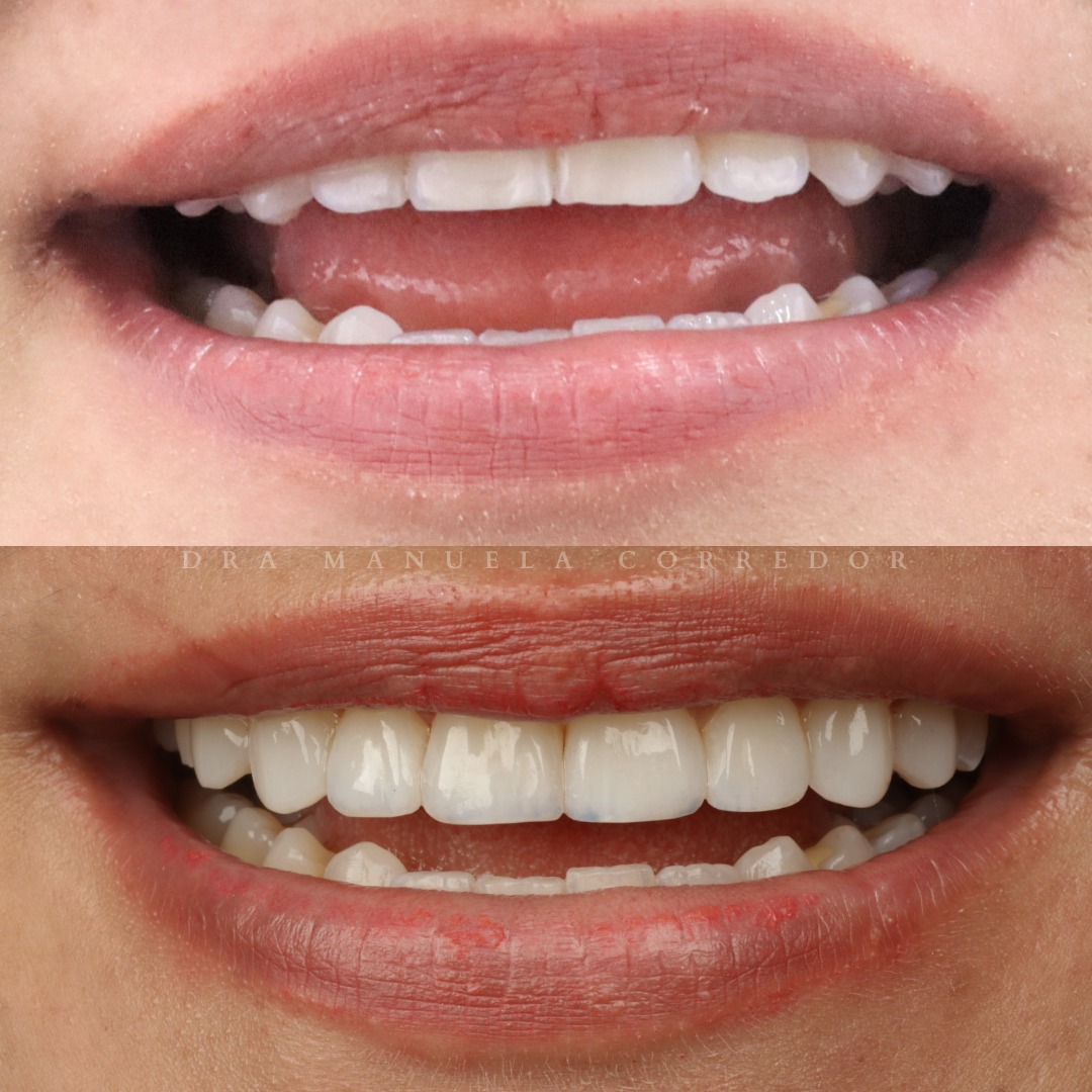Diseño estético dental
