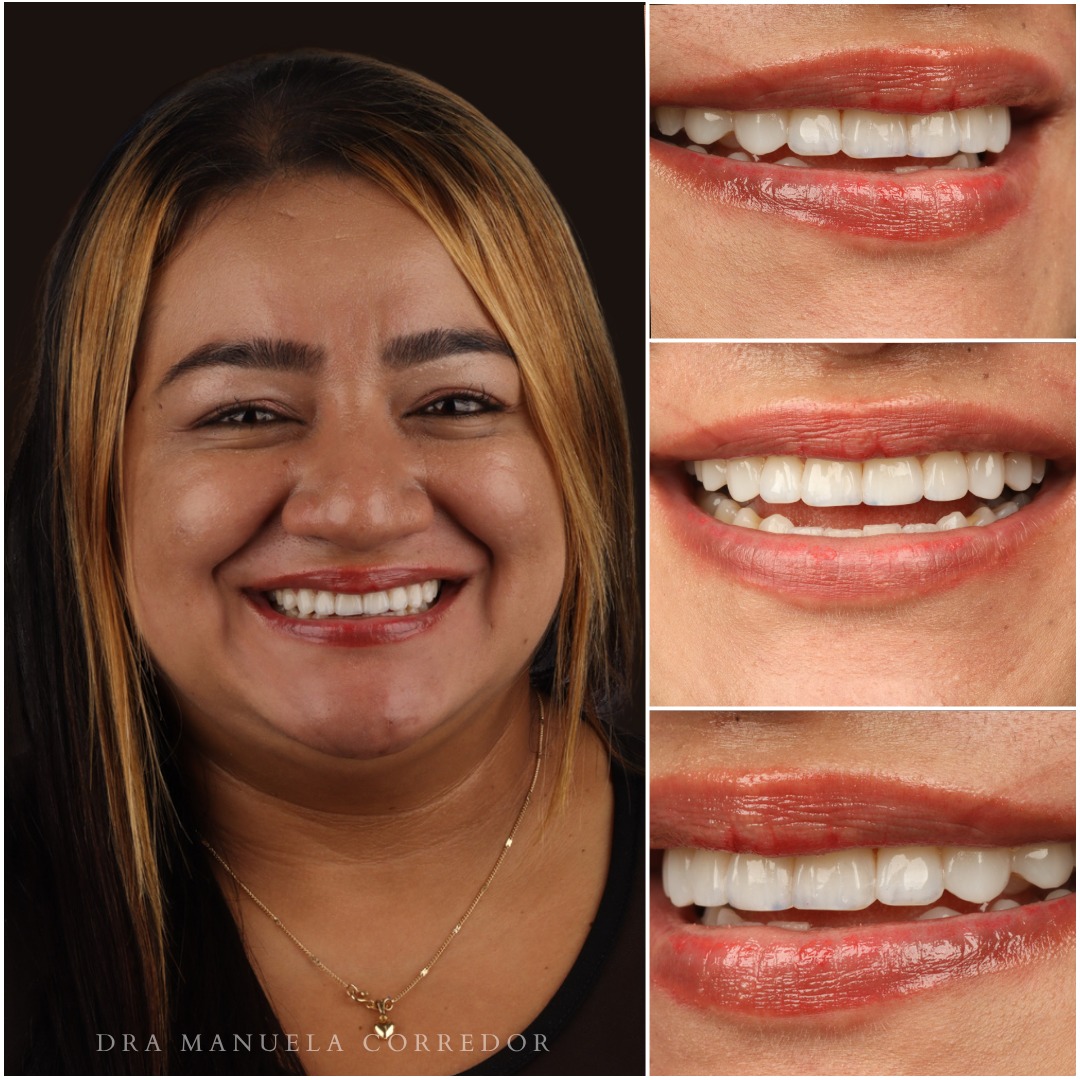 Antes y después diseño de sonrisa