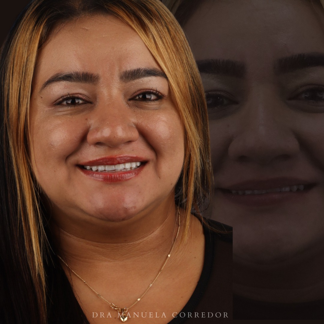 Caso clínico diseño de sonrisa