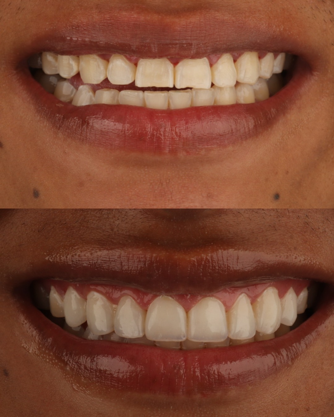 Diseño de sonrisa completo