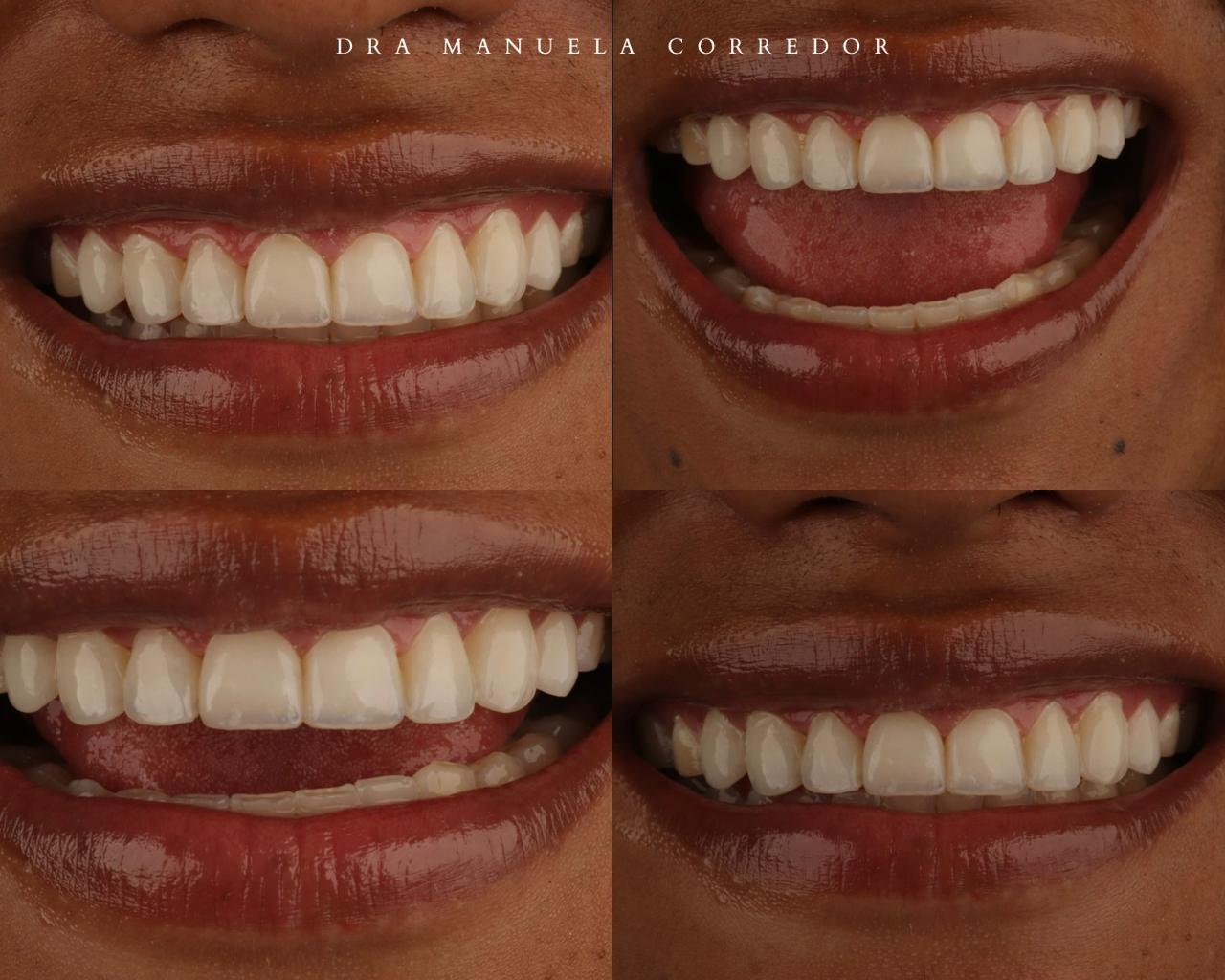 Resultado odontología estética