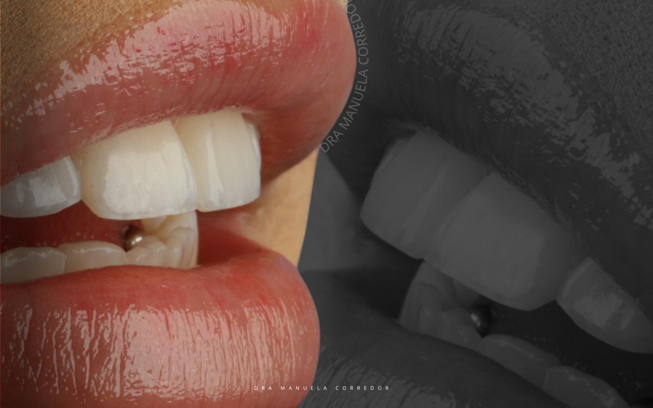 Transformación sonrisa